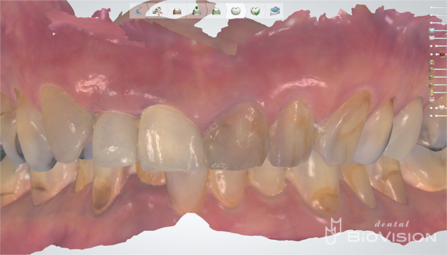 Glass-ceramic laminated veneer and monolithic zirconia crown