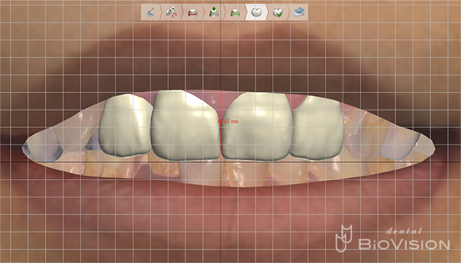 Glass-ceramic laminated veneer and monolithic zirconia crown