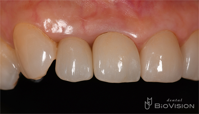 Glass-ceramic laminated veneer and monolithic zirconia crown