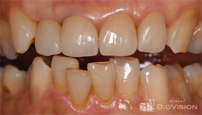 Glass-ceramic laminated veneer and monolithic zirconia crown