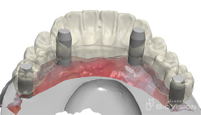 Mandibular screw retain full arch monolithic zirconia superstructure