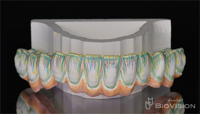 Mandibular screw retain full arch monolithic zirconia superstructure