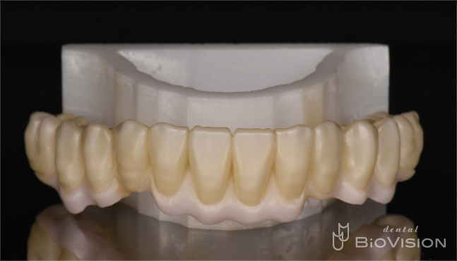 Mandibular screw retain full arch monolithic zirconia superstructure