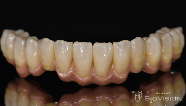 Mandibular screw retain full arch monolithic zirconia superstructure