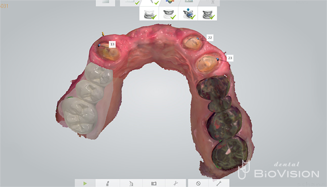 Maxillary 6 anterior teeth full zirconia bridge