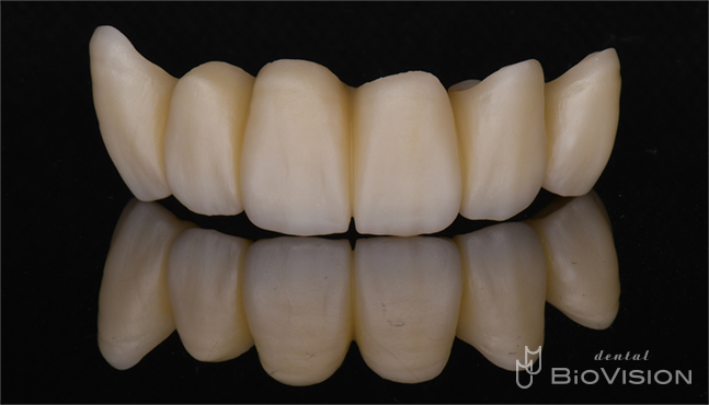 Maxillary 6 anterior teeth full zirconia bridge