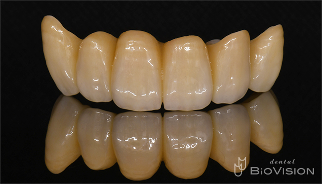 Maxillary 6 anterior teeth full zirconia bridge