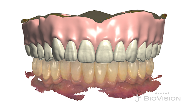 Maxillary metal plate full denture