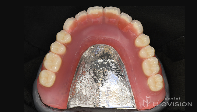 Maxillary metal plate full denture