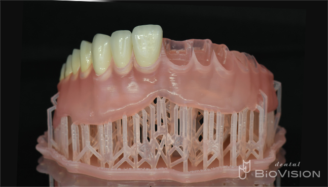 Maxillary metal plate full denture