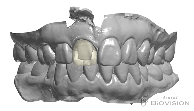 Maxillary single crown full zirconia From iTero