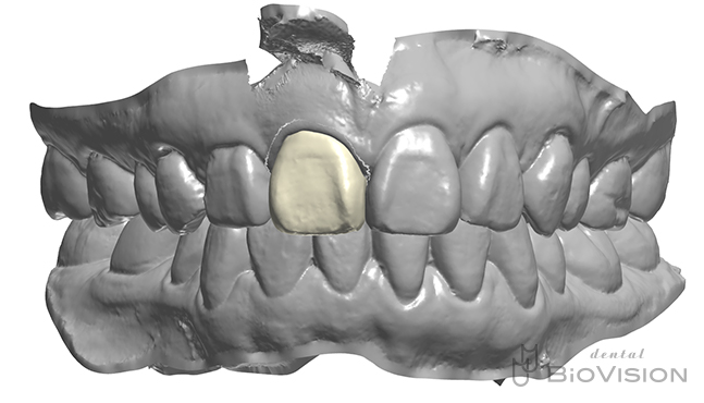 Maxillary single crown full zirconia From iTero