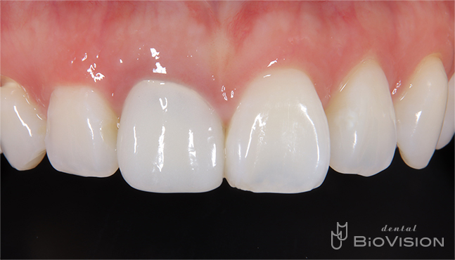 Maxillary single crown full zirconia From iTero