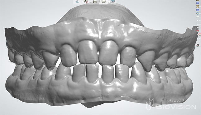 Upper and lower jaw setup & Digital Diagnostic Design From iTero