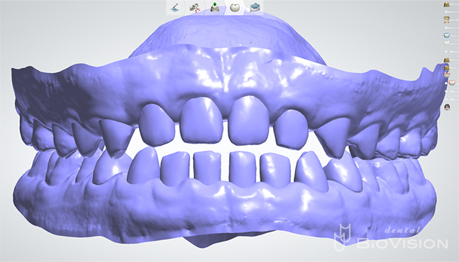 Upper and lower jaw setup & Digital Diagnostic Design From iTero