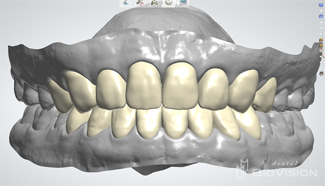 Upper and lower jaw setup & Digital Diagnostic Design From iTero