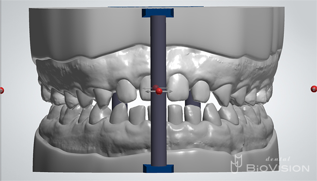 Upper and lower jaw setup & Digital Diagnostic Design From iTero