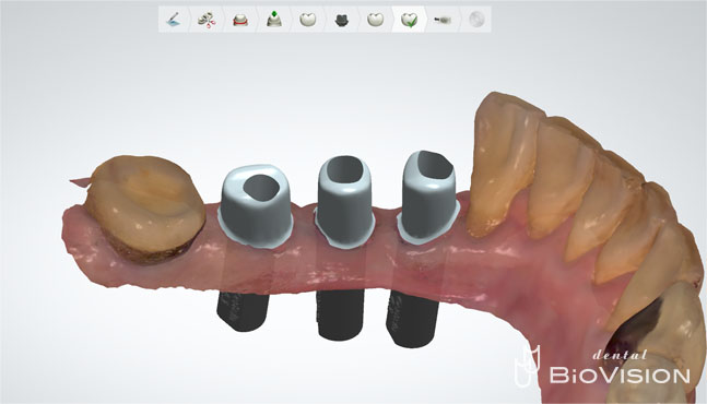 Ti Custom Abutment & Telescope Monolithic Zirconia Br (Non Printer Model)