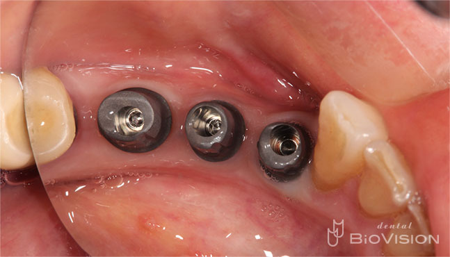 Ti Custom Abutment & Telescope Monolithic Zirconia Br (Non Printer Model)