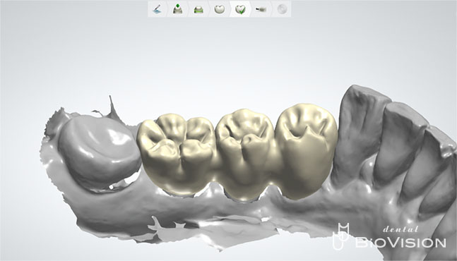 Ti Custom Abutment & Telescope Monolithic Zirconia Br (Non Printer Model)