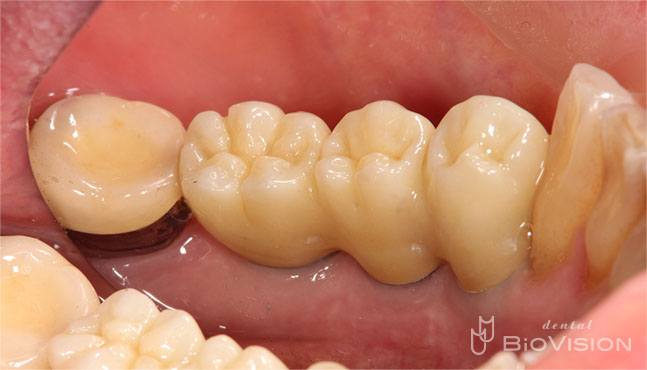 Ti Custom Abutment & Telescope Monolithic Zirconia Br (Non Printer Model)