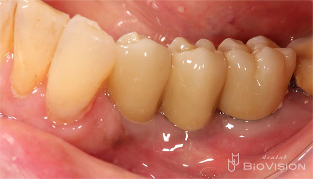 Ti Custom Abutment & Telescope Monolithic Zirconia Br (Non Printer Model)