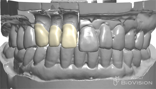 Layered Zirconia Ceramic Crowns