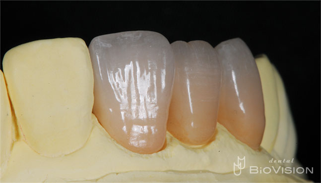 Layered Zirconia Ceramic Crowns