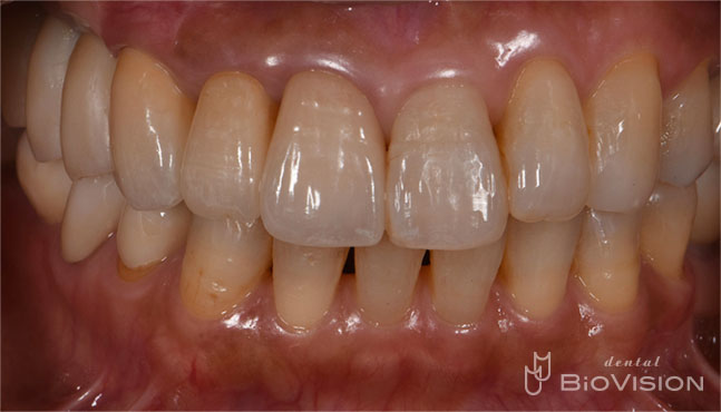 Layered Zirconia Ceramic Crowns