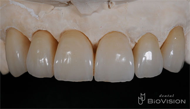 Layered Zirconia Ceramic Bridge