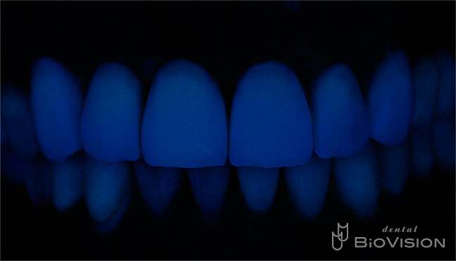 Layered Zirconia Ceramic Bridge