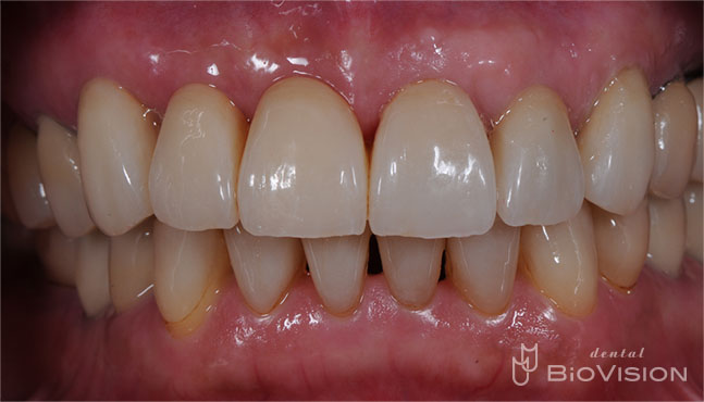 Layered Zirconia Ceramic Bridge