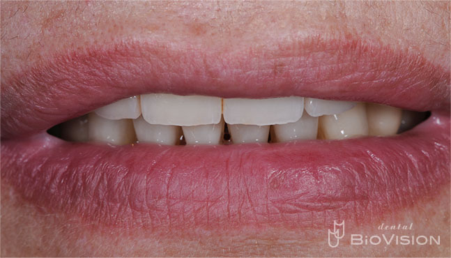 Layered Zirconia Ceramic Bridge