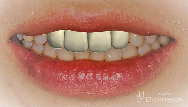 Half Layered Press Ceramic Crowns