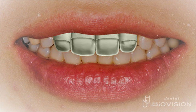 Half Layered Press Ceramic Crowns