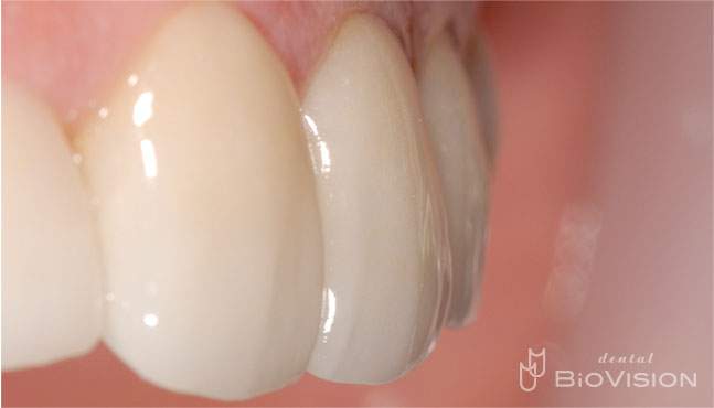 Half Layered Press Ceramic Crowns