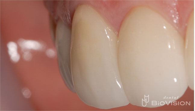 Half Layered Press Ceramic Crowns