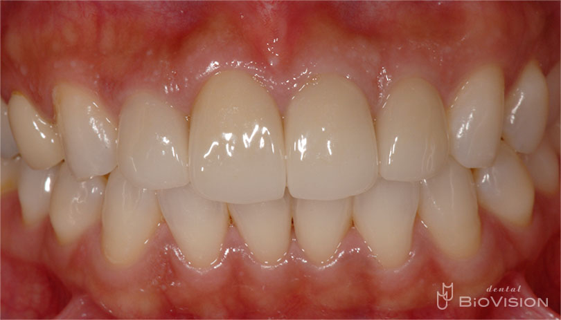 Half Layered Press Ceramic Crowns