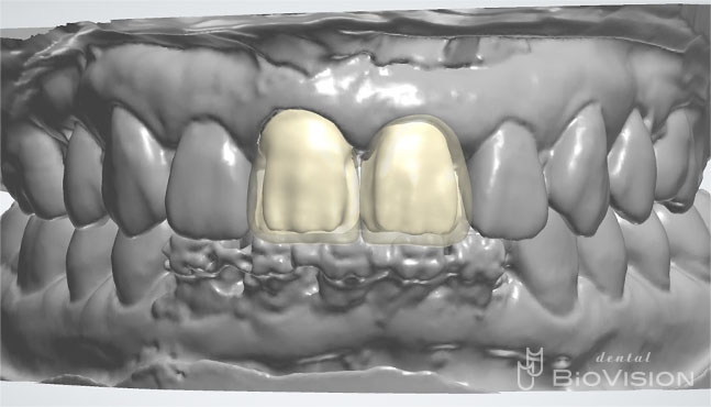 Layered Zirconia Ceramic Cr & Screw Retained Zirconia Ceramic 