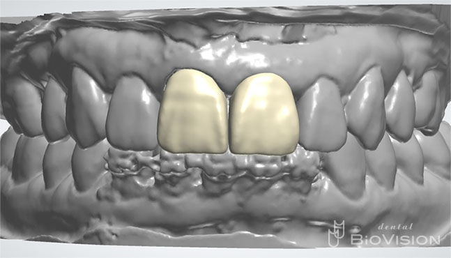 Layered Zirconia Ceramic Cr & Screw Retained Zirconia Ceramic 