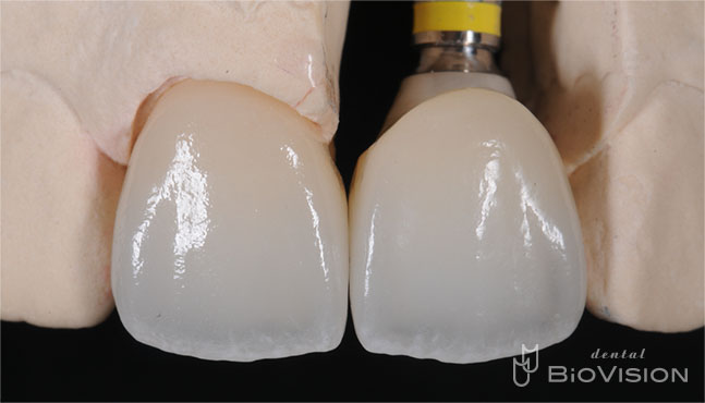 Layered Zirconia Ceramic Cr & Screw Retained Zirconia Ceramic 