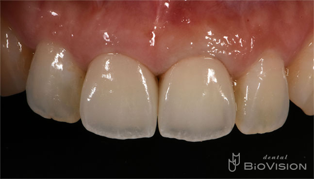 Layered Zirconia Ceramic Cr & Screw Retained Zirconia Ceramic 