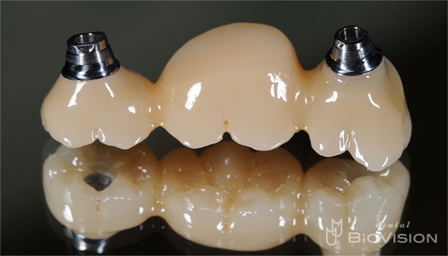 Screw Retained Monolithic Zirconia Br