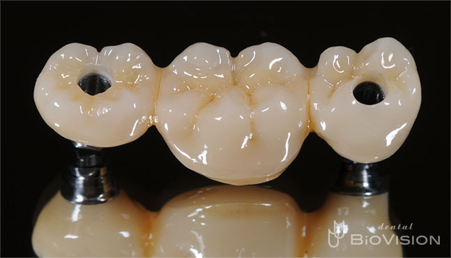 Screw Retained Monolithic Zirconia Br