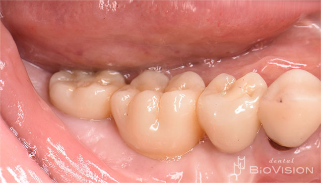 Screw Retained Monolithic Zirconia Br