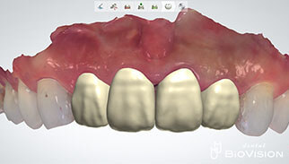 Half Layered Zirconia Ceramic Crowns