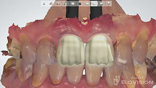 Screw Retained Layered Zirconia & 3D Printer Model