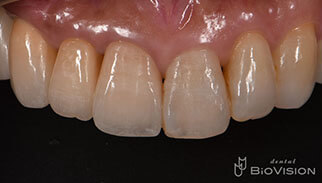 Layered Zirconia Ceramic Crowns