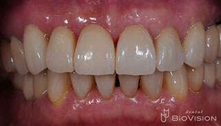 Layered Zirconia Ceramic Bridge