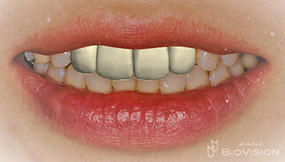 Half Layered Press Ceramic Crowns